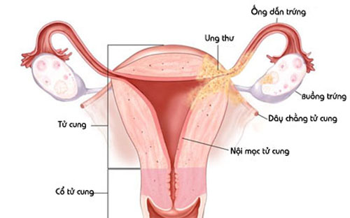 Top 5 nguyên nhân gây ra cục máu đông trong ngày "đèn đỏ" 1